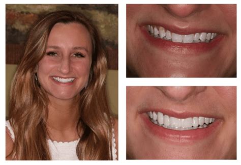 Cosmetic dental bonding cookeville, tn  Please come and visit Knoxville, TN dentist Dental Images, PC